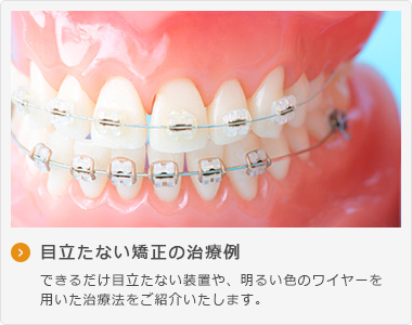 目立たない矯正の治療例 できるだけ目立たない装置や、明るい色のワイヤーを 用いた治療法をご紹介いたします。