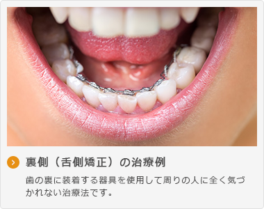 裏側（舌側矯正）の治療例 歯の裏に装着する器具を使用して周りの人に全く気づ かれない治療法です。